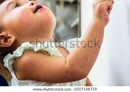 Detail of left arm skin on children with Roseola, Roseola infantum, Exanthem submitted or the Sixth disease of rash from food allergy and drug allergy, and chemicals allergy.