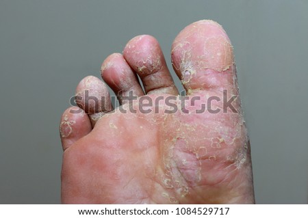 Athlete\'s foot - tinea pedis, fungal infection