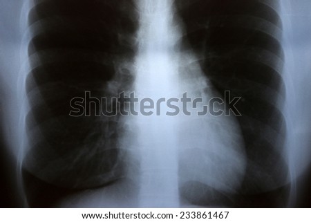 Heart Attack On Patient X-Ray