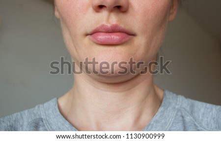 sagging chin. face line correction