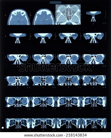 X-ray photograph, Computer tomography, head
