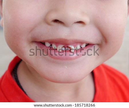 boy with a teeth broken and rotten
