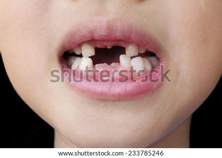 broken tooth
