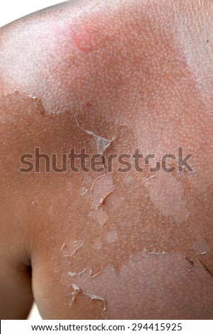 sunburned peeling on chest body
