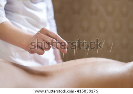 needle acupuncture procedure; acupuncturist doctor makes a therapy for woman;