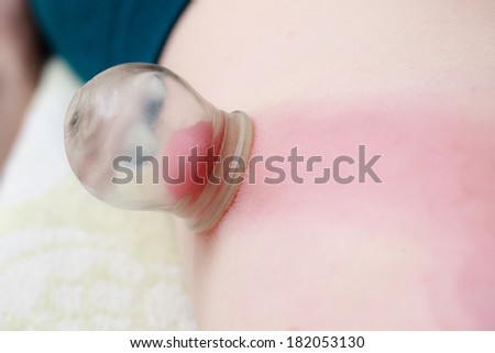 Alternative medicine health care. Fire cupping procedure, woman receiving vacuum cupping massage treatment, detail on female back.