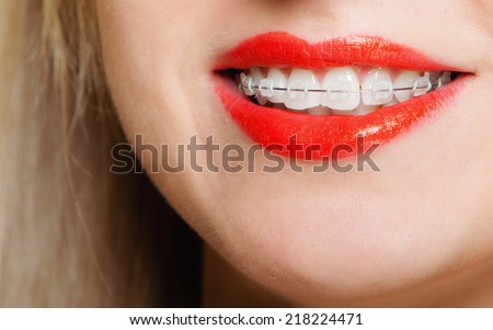 Happy smiling girl with dental braces face part - teeth straighten tooth hygiene, dentistry clinic healthy lifestyle.