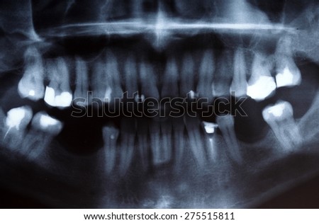 Panoramic x-ray image scan of humans teeth