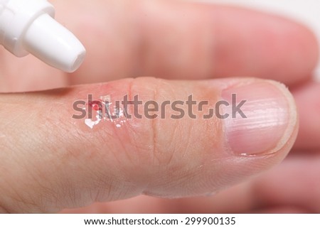 disinfect the scratch by rubbing in alcohol cuts on the hand