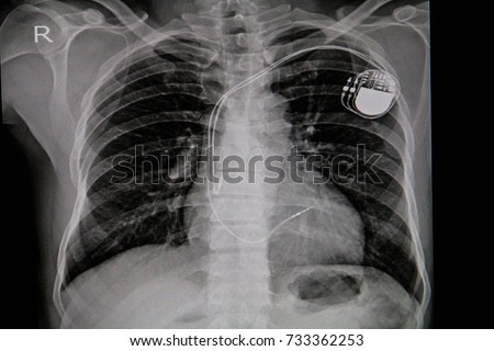 Chest x-ray image of permanent pacemaker implant in body chest.