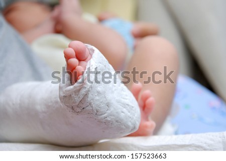 Baby Foot In Bandage And Cast