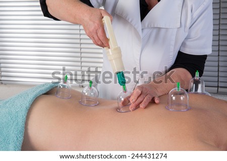 Medical Hijama cupping therapy on human body