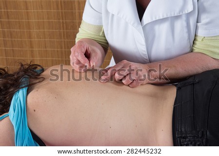 Doctor putting acupuncture needles on woman\'s shoulder,close-up