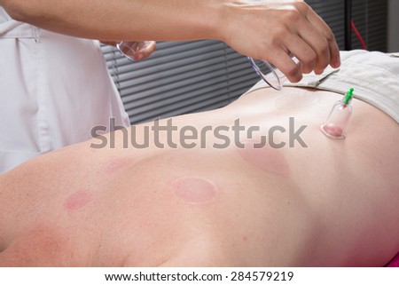 Detail of an acupuncture therapist removing a plastic  globe in a  cupping procedure