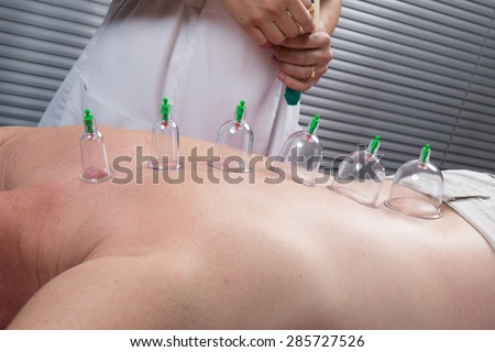 Multiple vacuum cup of medical cupping therapy on human body