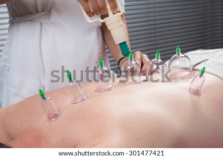Cupping therapy, spa, woman doctor removes cups from the patient\'s back