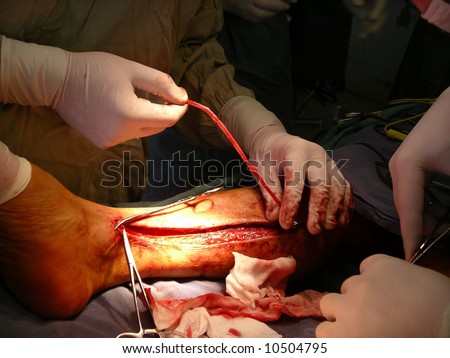 A surgeon pick out a vein to heart bypass surgery