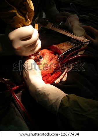 Heart laser surgery