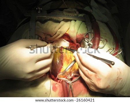 Coronary artery bypass surgery using heart-lung machine