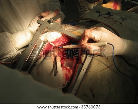 Surgery for coronary artery disease using off-pump technique (OPCAB)