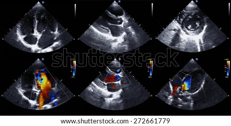 Echocardiography set of patterns Echocardiography set of patterns