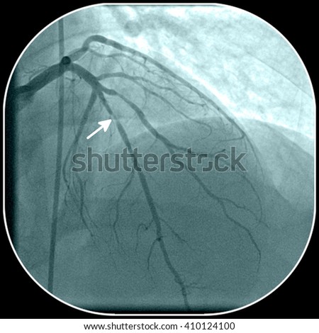 Coronary artery disease. Stenosis of the left anterior descending coronary artery on angiography (marked by arrow)