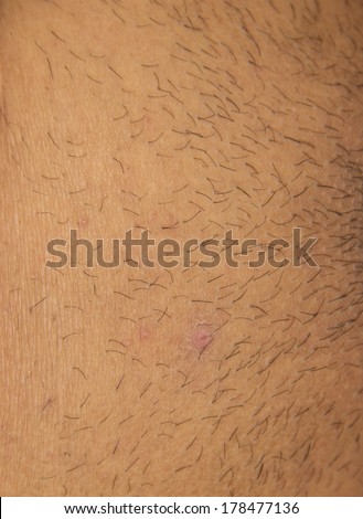 dry skin (ichthyosis) detail