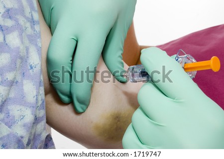 Gloved hands giving injection of blood thinner to back of arm.  Bruses and scars from previous injections visible.