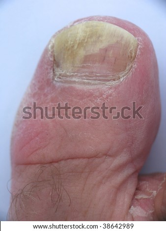 Foot Mycosis