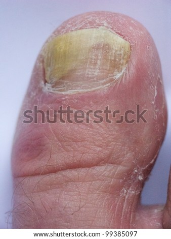 stock photo : Big toe with nail infection. Save to a lightbox ▼