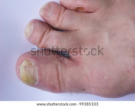 Fungal infection of the foot