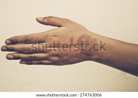 female hand with wound scar