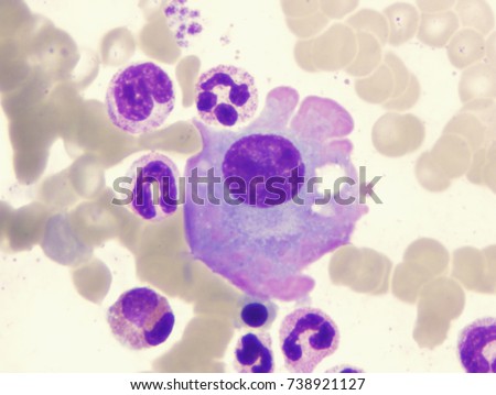 Multiple myeloma (showing flame-shaped plasma cell)