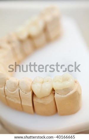 Ceramic teeth inlays in a dental lab