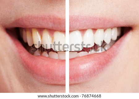 Comparison of teeth before and after bleaching session