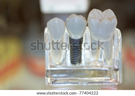 COLOGNE - MARCH 24: New teeth model showing an implant crown bridge model on display at the HANIL DENT booth at the IDS Dental Industry trade show in Cologne, Germany on March 24, 2011.