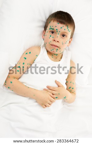 child has the virus on skin, white background