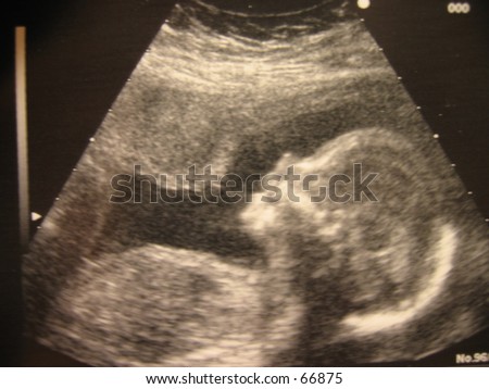 Ultrasound of a baby Ultrasound of a baby