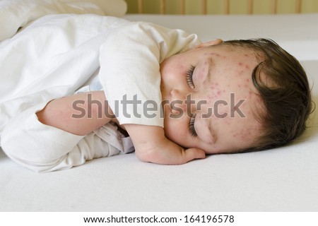 Portrait of a sleeping child with red spots on his skin of chicken pox.