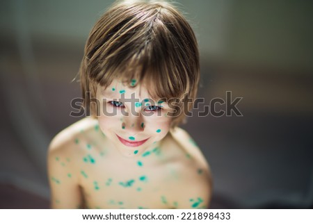 A little cute smiling boy with chicken pox sitting on the floor