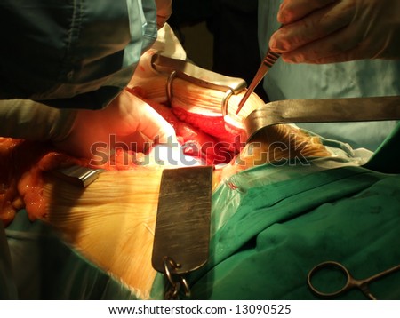 Abdominal Plastic Surgery Pictures on Abdominal Surgery Stock Photo 13090525   Shutterstock