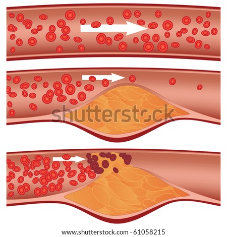 Cholesterol Plaque