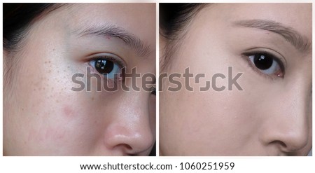A comparison of an Asian woman before and after makeup, undergone dermatological treatment for dark spots, dark circles and acne.
