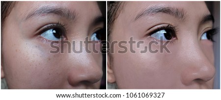 Comparison of before and after undergone skin treatment and makeup.