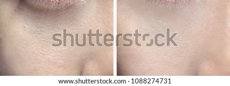 Comparion of before and after undergoing dark circle under eye therapy. Whether to use eye cream or dermatology process and makeup.