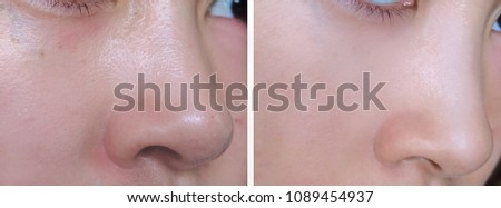 Facial skin before and after using makeup base compared to show the smoother and brighter skin.