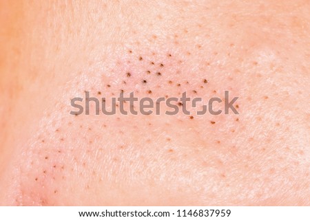 blackheads on the skin close-up
