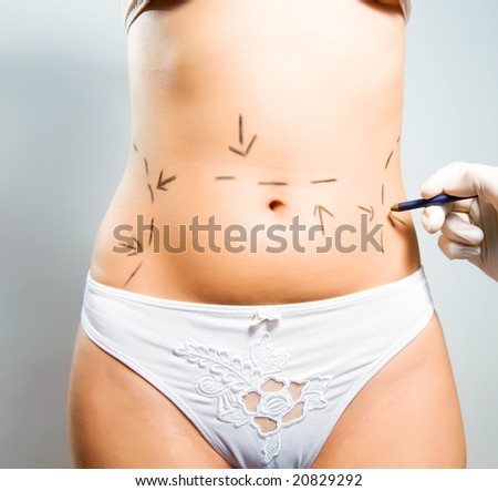 Drawing lines on a Caucasian woman's abdomen as marks for abdominal cellulite cosmetic correction surgery