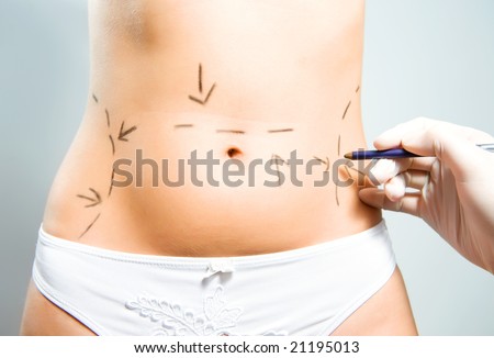 Drawing lines on a Caucasian lady's abdomen as marks for abdominal cellulite correction cosmetic surgery