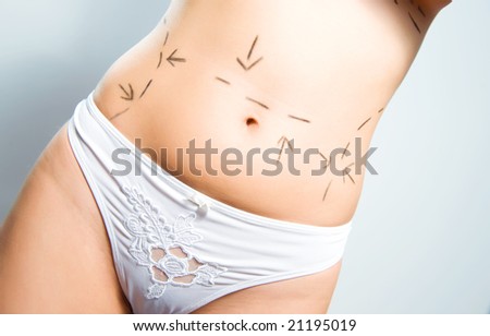 Closeup photo of a Caucasian woman\'s abdomen  marked with lines for abdominal cellulite correction cosmetic surgery